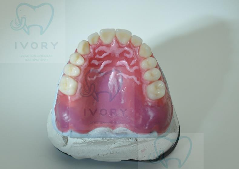 Постановка зубов на воске (верхняя челюсть )